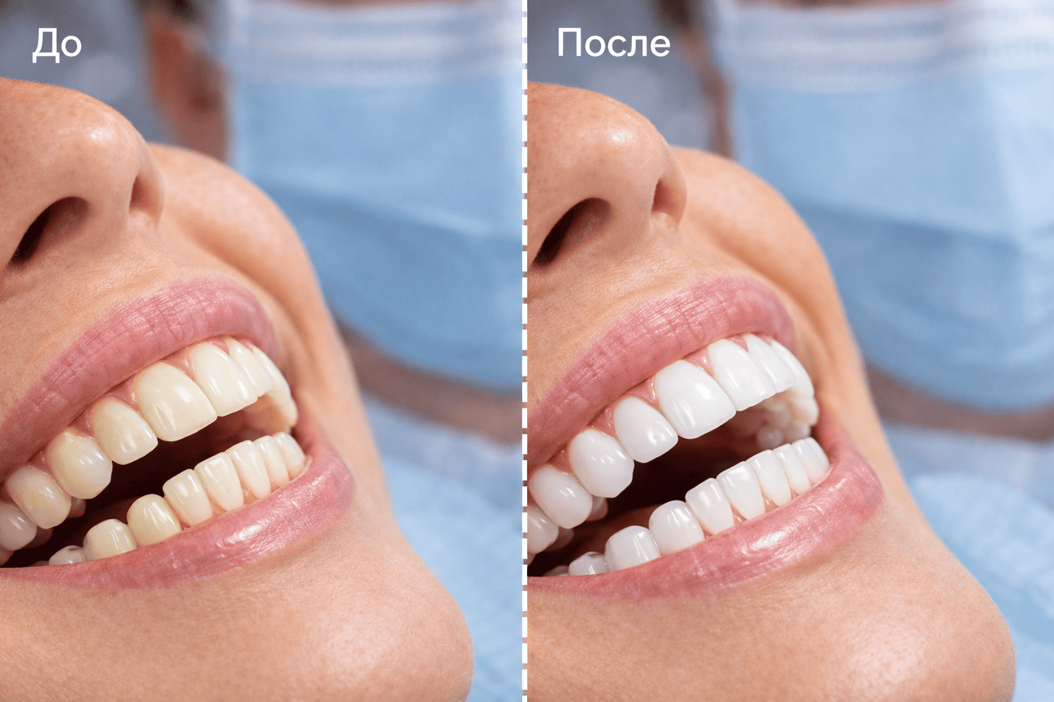 результат процедуры после Air Flow